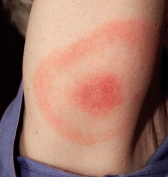 bug-bite