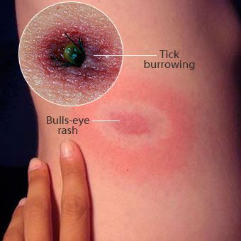 bulls-eye-rash