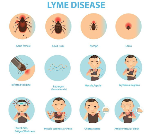 Clinical Symptoms of Lyme disease