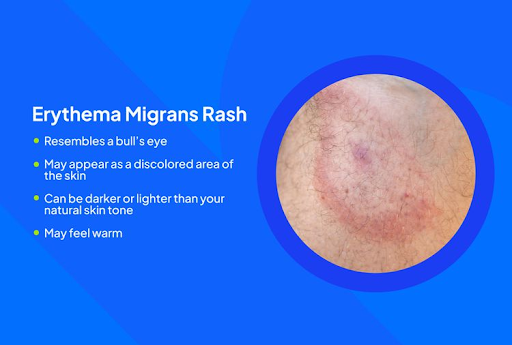 Lyme Disease Happen Without a Rash.png