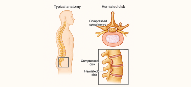 man-with-pain-his-back