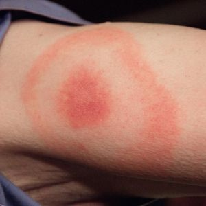 mosquito-bite