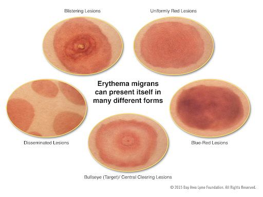erythema migrans