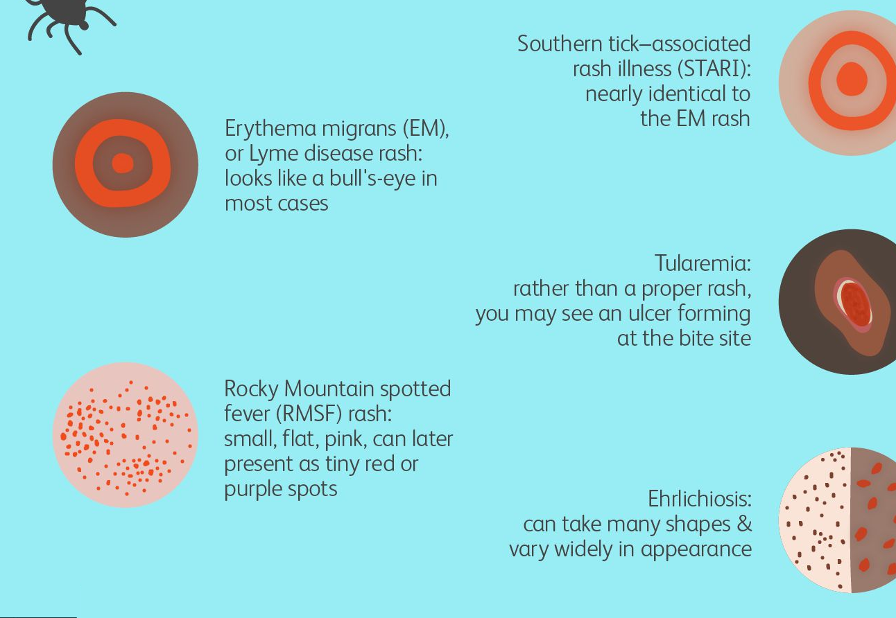 why-is-the-tick-bite-rash.png