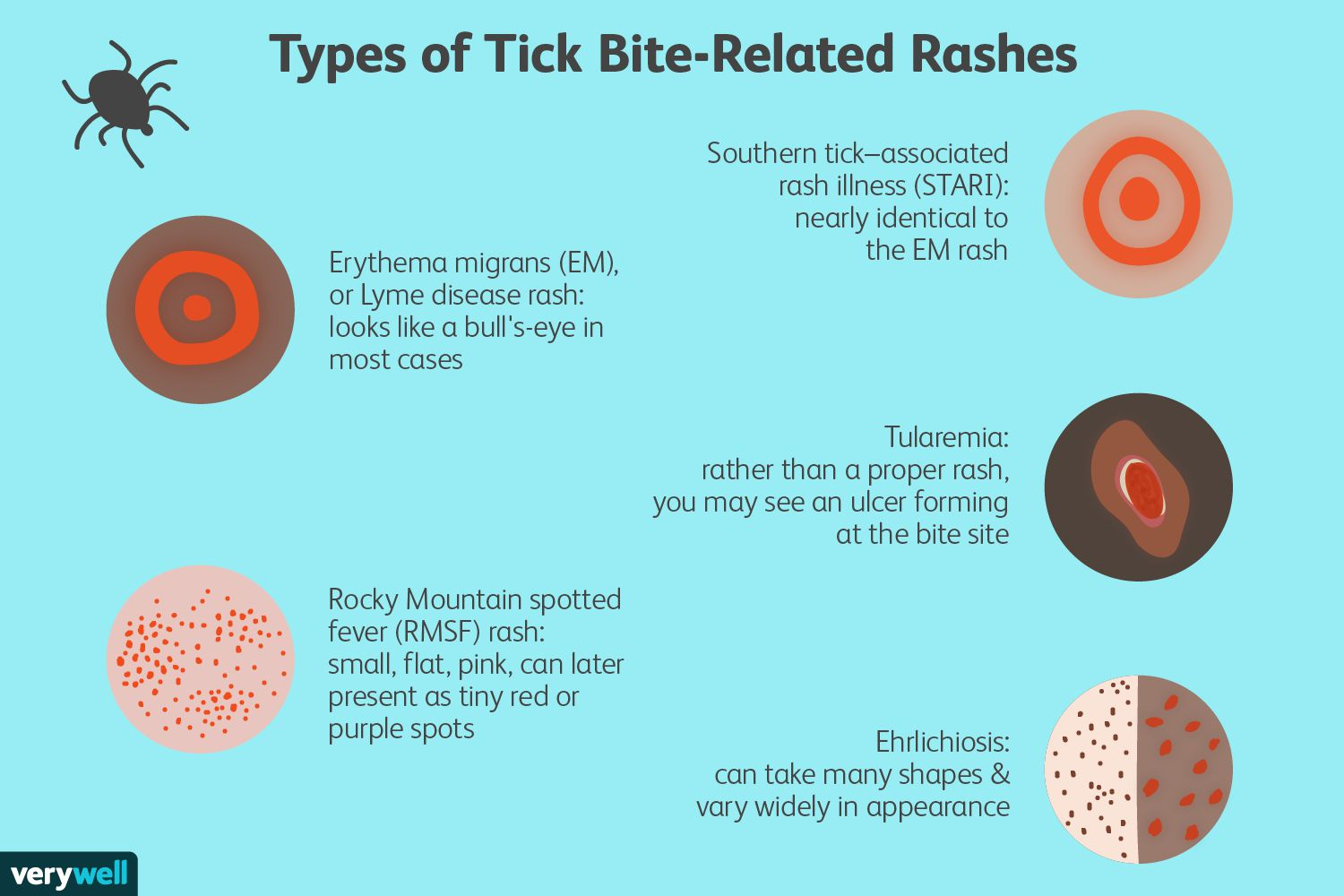 Why Is the Tick Bite Rash So Important.png